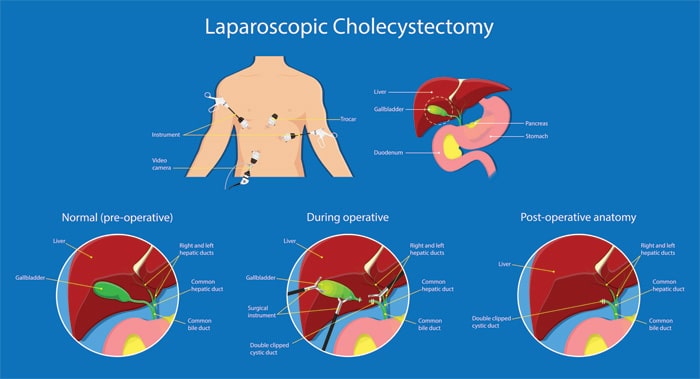 Θεραπεία Παθήσεων Χολολιθίασης 1 λαπαροσκοπιση χολοκυστεκτομη