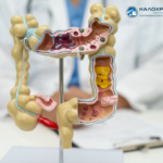 απόφραξη εντέρου