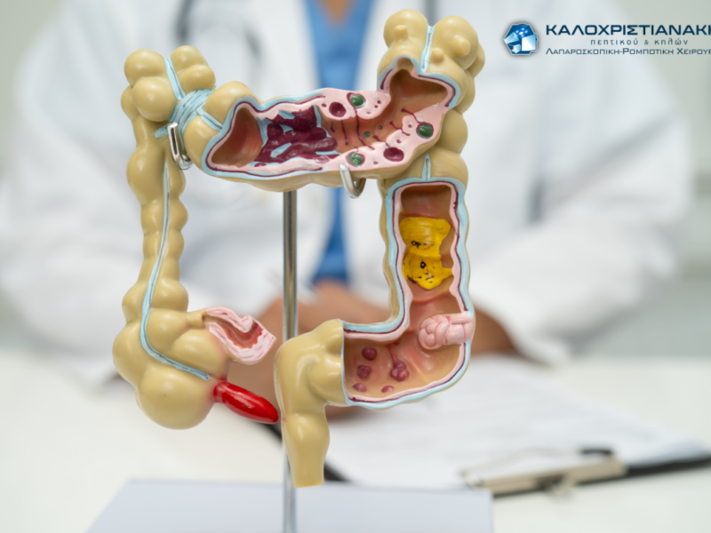 Απόφραξη Εντέρου: Από τη Διάγνωση στη Θεραπεία — Ο Πλήρης Οδηγός