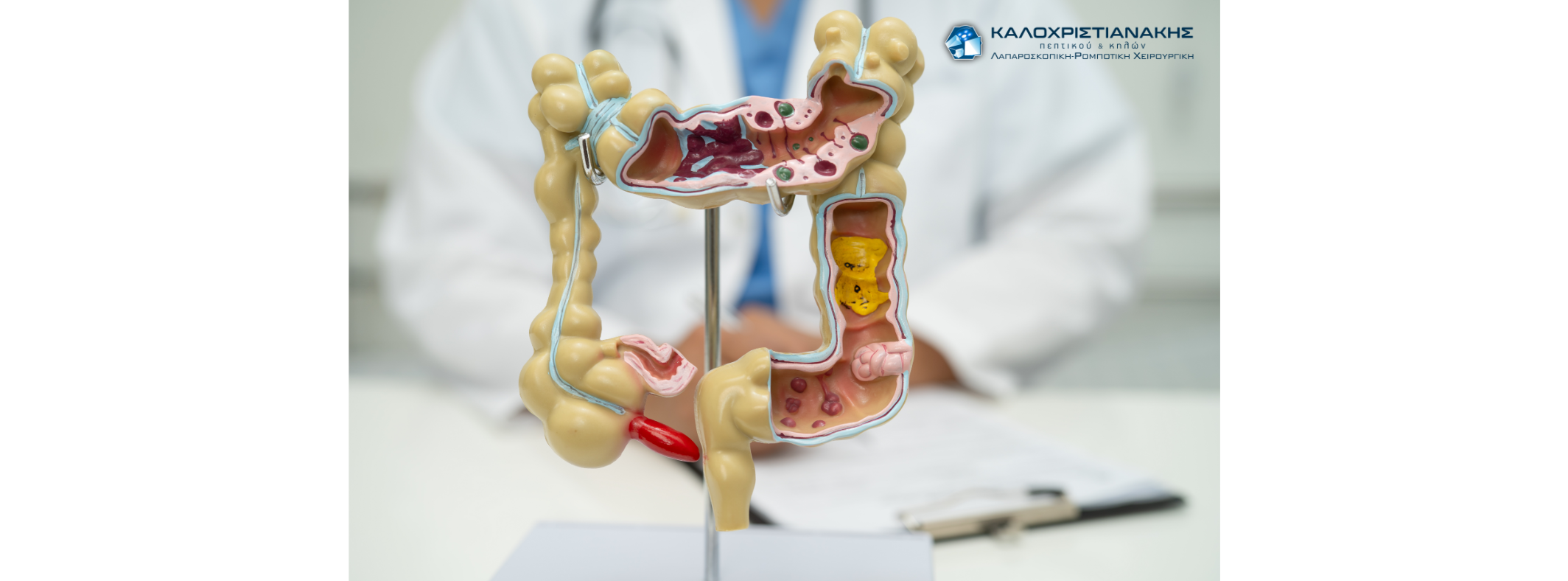 Απόφραξη Εντέρου: Από τη Διάγνωση στη Θεραπεία — Ο Πλήρης Οδηγός